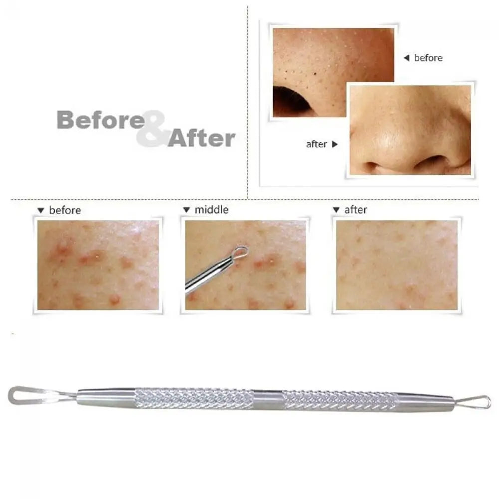Stainless Steel Blackhead and Blemish Extractor Tool with Dual Loop Needles for Acne Treatment and Skin Care